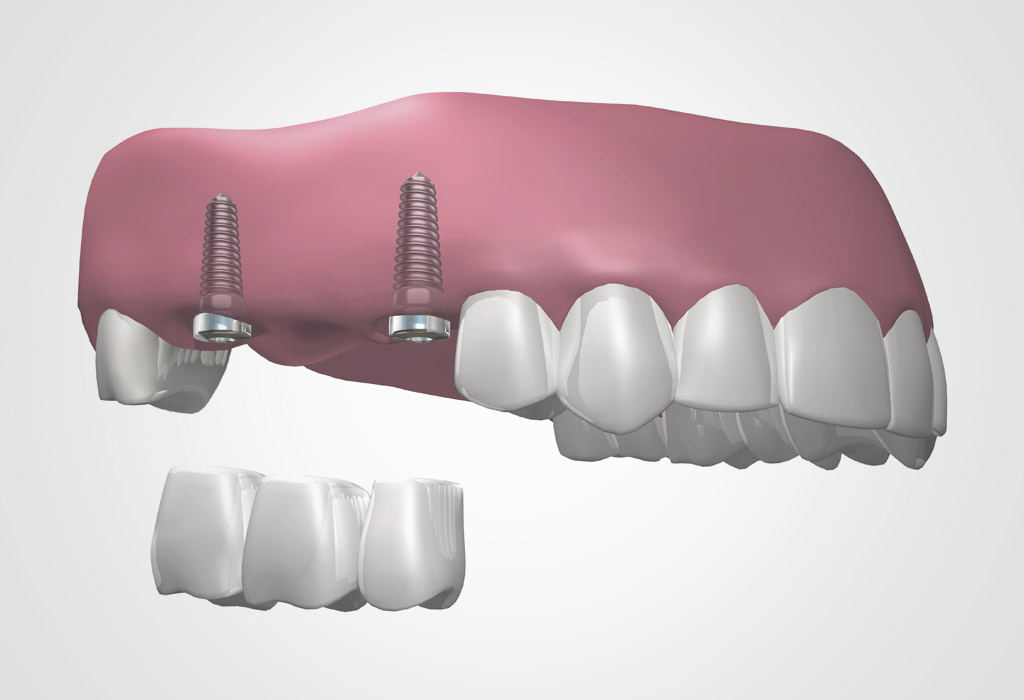 implantes dentales en Palau-solità i Plegamans