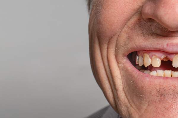 Boca sin dientes: Soluciones para recuperar una sonrisa completa